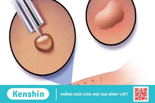 Dị ứng mít: Cẩm nang cho người bị dị ứng 3