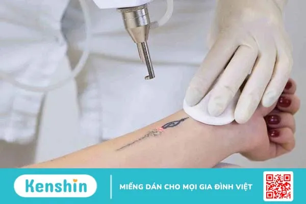 Dị ứng mực xăm là thế nào? Cách nhận biết và điều trị da bị dị ứng sau khi xăm 1