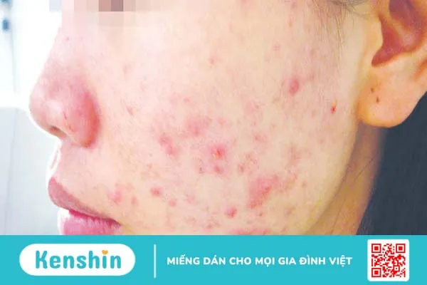 Dị ứng mỹ phẩm có tự hết không? 3