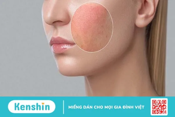 Dị ứng mỹ phẩm nên bôi thuốc gì? 1