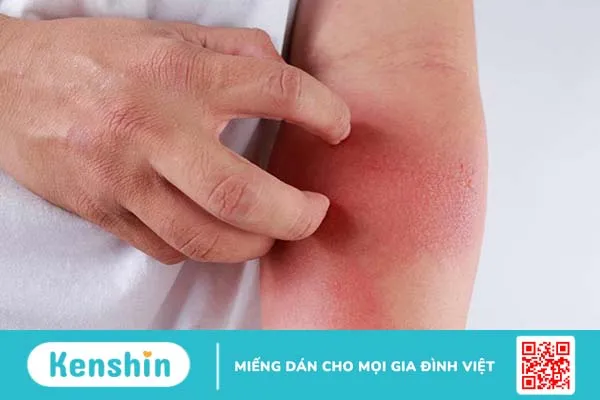 Có hai loại dị ứng thời tiết là dị ứng thời tiết nóng và lạnh