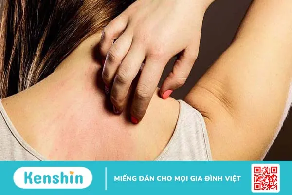 Dị ứng thời tiết có lây không là câu hỏi thắc mắc của nhiều người