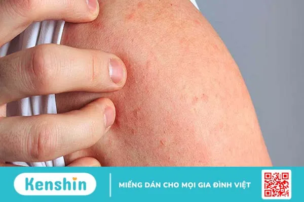 Dị ứng vật nuôi là gì? Nguyên nhân và cách điều trị