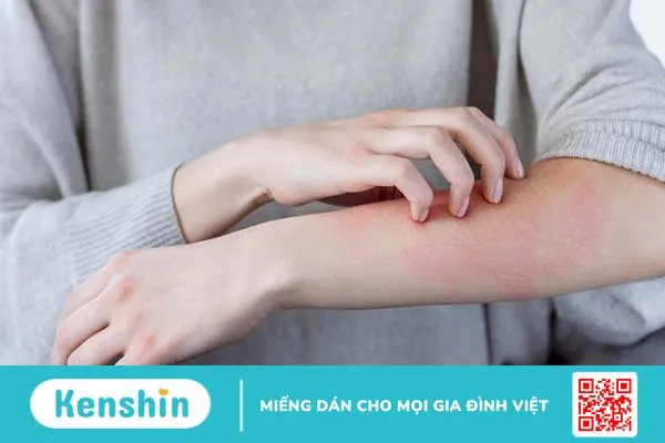 Dị ứng với cây họ đậu là thế nào? Triệu chứng nhận biết và cách điều trị ra sao? 4