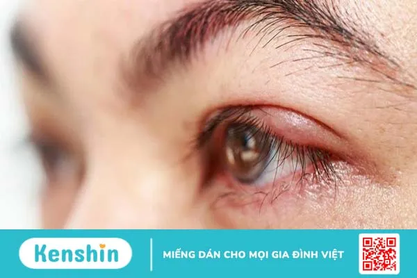 Dị ứng vùng da quanh mắt có nguy hiểm không? 1