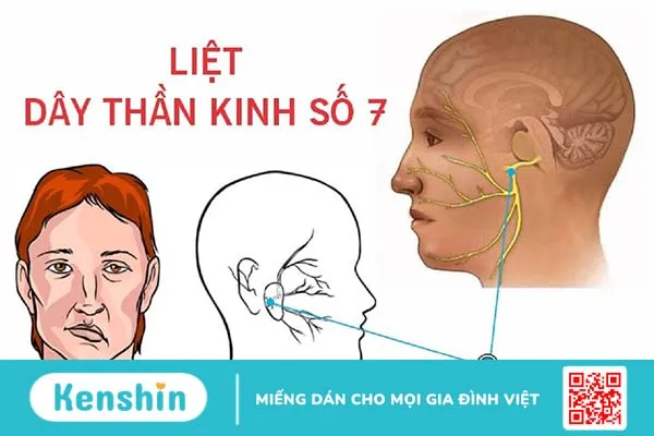 Điện châm điều trị liệt dây thần kinh số 7 và cách phòng tránh bệnh này 1