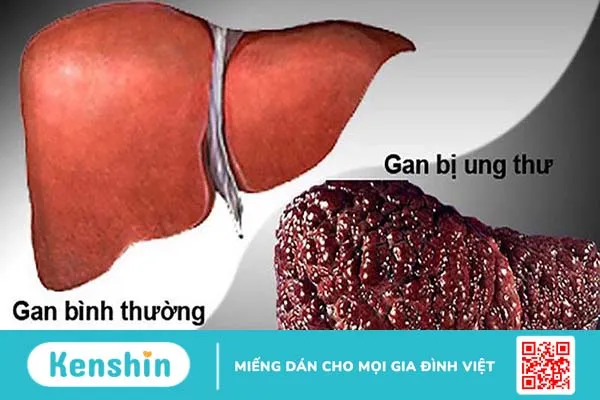 Chẩn đoán ung thư gan nguyên phát