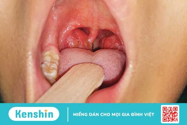 Điều trị viêm VA cấp tính ở trẻ và biến chứng nếu không chữa trị kịp thời 1