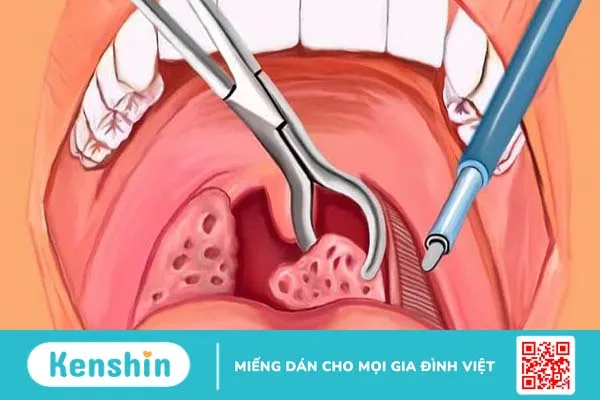 Điều trị viêm VA cấp tính ở trẻ và biến chứng nếu không chữa trị kịp thời 2