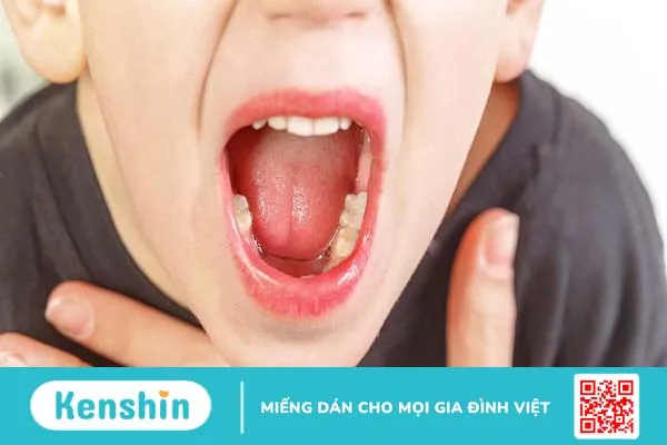 Hai giai đoạn viêm VA cấp tính và viêm VA mạn tính và cách điều trị 2