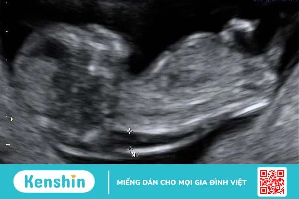 Độ mờ da gáy 3.2mm có bình thường không? 1