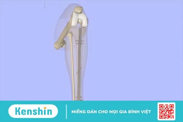 Đóng đinh nội tủy là thế nào? Ưu điểm và rủi ro của phương pháp đóng đinh nội tủy 1