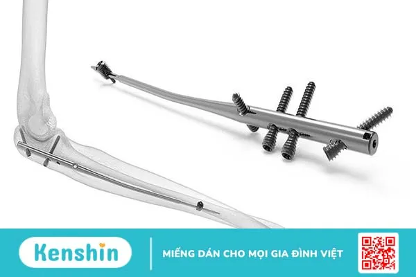 Đóng đinh nội tủy là thế nào? Ưu điểm và rủi ro của phương pháp đóng đinh nội tủy 3