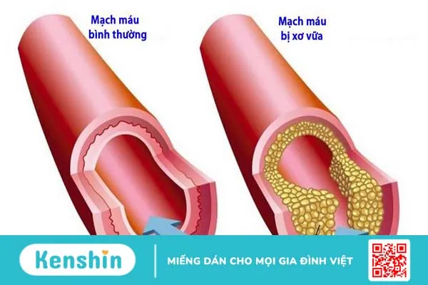 Động mạch chậu: Cấu trúc, chức năng và các bệnh lý thường gặp 3