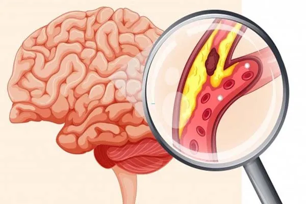 Đột quỵ do tắc mạch từ tim nguy hiểm không? Nguyên nhân, triệu chứng và chẩn đoán 1