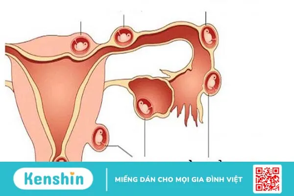 Đừng chủ quan trước những ảnh hưởng của tiêm thuốc rụng trứng đối với cơ thể 4