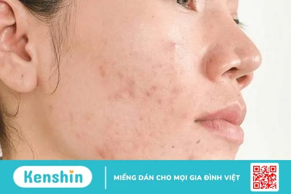 Dùng retinol bị lên mụn xử trí như thế nào?-2