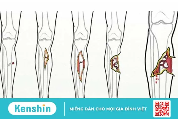 Gãy xương hở: Nguyên nhân, biến chứng và cách điều trị 1