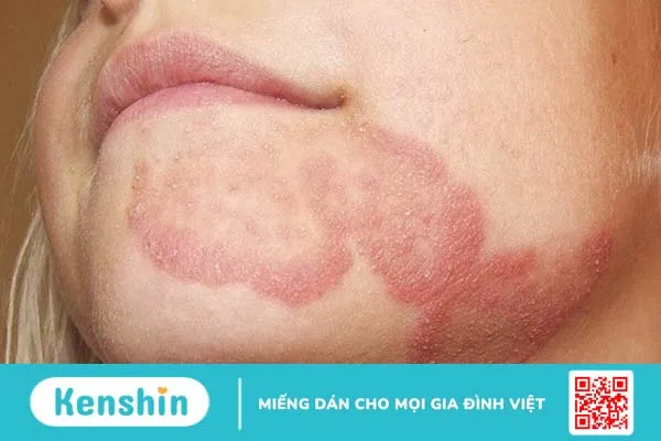 Giải đáp: Bệnh hắc lào có lây nhiễm không 1