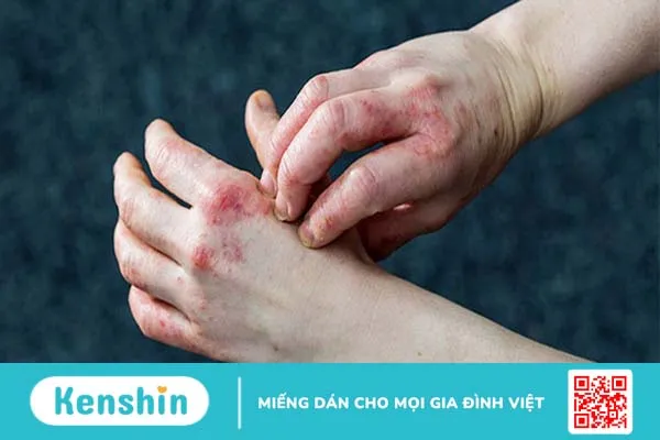 Giải đáp: Bệnh hắc lào có lây nhiễm không 2