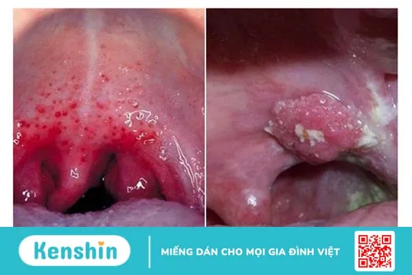 Giải đáp: Bệnh nấm họng có lây không 1