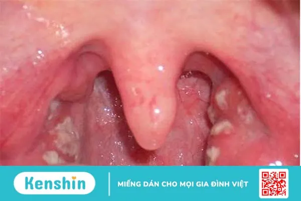 Giải đáp: Bệnh nấm họng có lây không 2