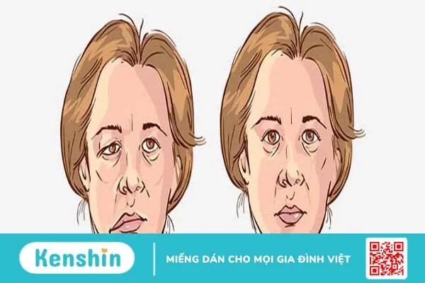 Bị liệt dây thần kinh số 7 có tự khỏi không?