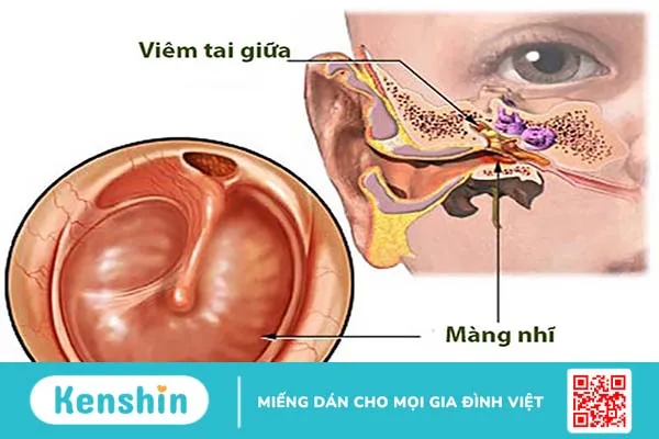 Giải đáp: Mổ viêm tai giữa nằm viện bao lâu?