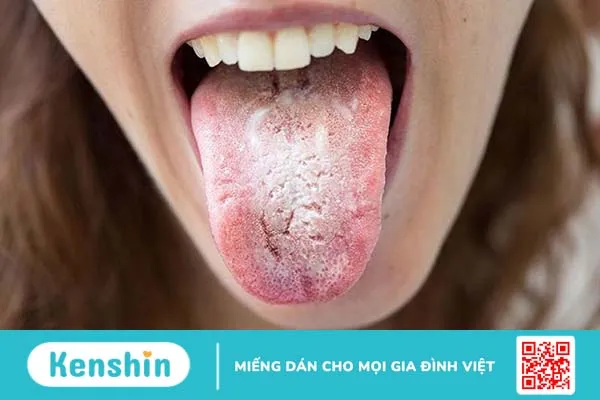 Giải đáp: Nấm họng có nguy hiểm không 2