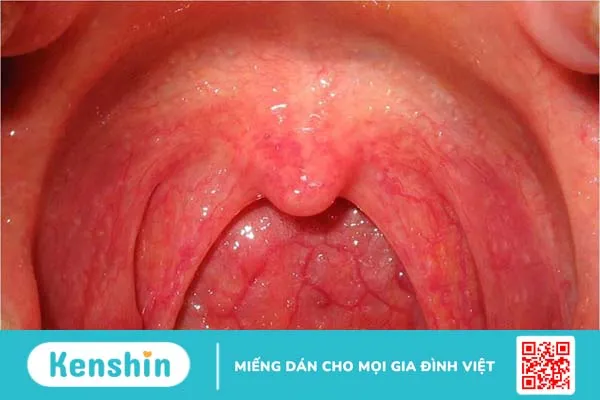 Giải đáp: Nấm họng uống kháng sinh gì? Loại nào bán chạy nhất 1