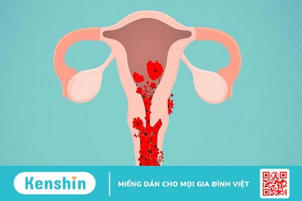 Khi bị rong kinh, thời gian hành kinh sẽ kéo dài hơn 7 ngày và cơ thể mất hơn 80ml máu