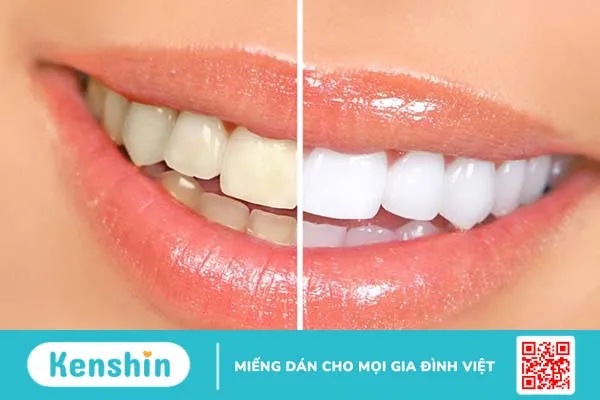 Tẩy trắng răng giúp cải thiện màu răng trắng sáng hơn ban đầu