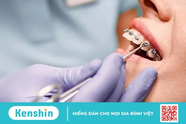 Giải đáp thắc mắc: 25 tuổi niềng răng được không 2