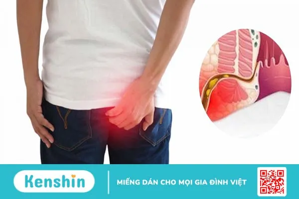 Nguyên nhân gây bệnh trĩ? Bệnh trĩ có lây không?