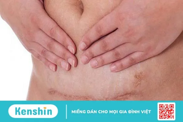 Giải đáp thắc mắc: Đau vết mổ đẻ cũ khi mang thai có nguy hiểm không? 1