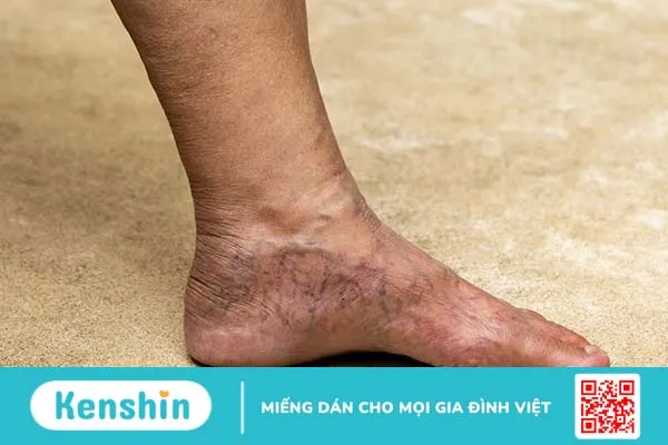 Giải đáp thắc mắc: Giãn tĩnh mạch nông chi dưới là gì? 1