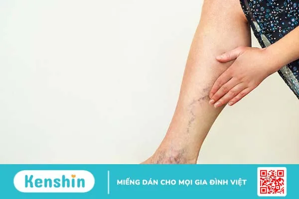 Giải đáp thắc mắc: Giãn tĩnh mạch nông chi dưới là gì? 2