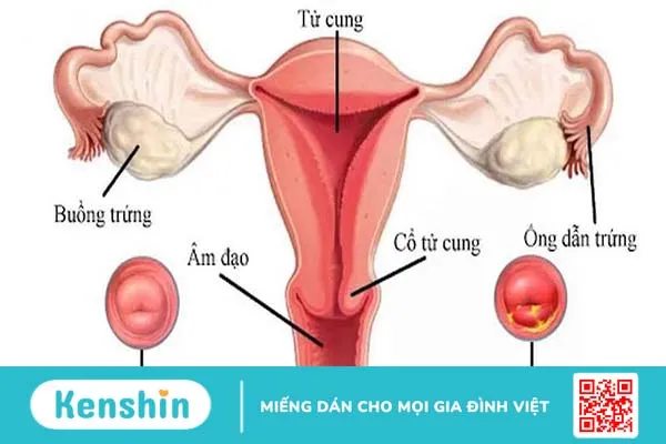 Giải đáp thắc mắc về viêm lộ tuyến tử cung có thai được không? 1