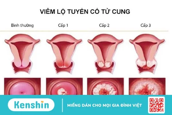 Giải đáp thắc mắc: Viêm lộ tuyến tử cung có lây không? 1