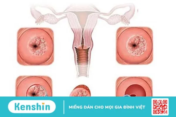 Giải đáp thắc mắc: Viêm lộ tuyến tử cung có lây không? 2