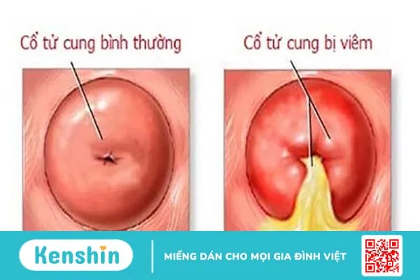 Giải đáp thắc mắc: Viêm lộ tuyến tử cung có lây không? 3