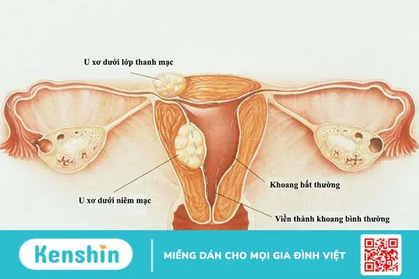 Giải đáp: u xơ tử cung có ăn sữa chua được không? 1