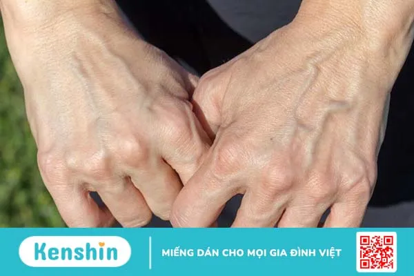 Giãn tĩnh mạch tay là gì? Nguyên nhân, cách điều trị và biện pháp phòng tránh 1