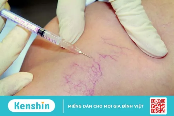 Giãn tĩnh mạch tay là gì? Nguyên nhân, cách điều trị và biện pháp phòng tránh 3