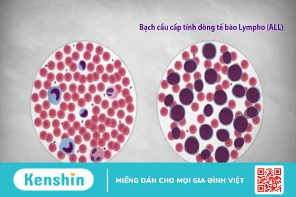 Giới thiệu về bệnh bạch cầu cấp dòng lympho ở trẻ em 1