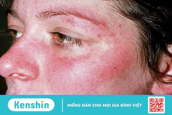 [GÓC GIẢI ĐÁP] Bệnh lupus ban đỏ hệ thống lây không? 1