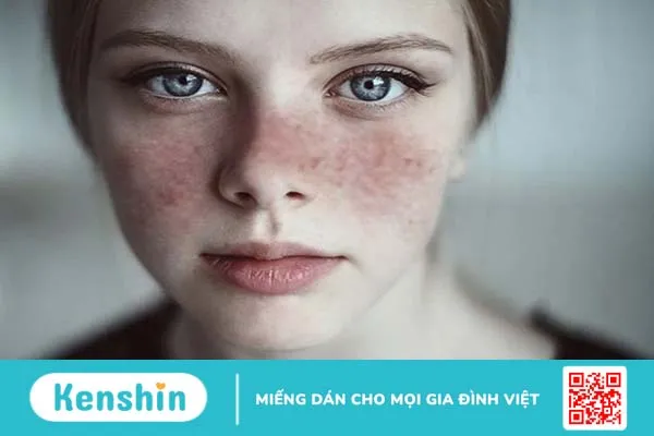 [GÓC GIẢI ĐÁP] Bệnh lupus ban đỏ hệ thống lây không? 2