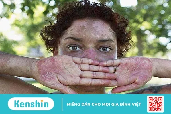 [GÓC GIẢI ĐÁP] Bệnh lupus ban đỏ hệ thống lây không? 3