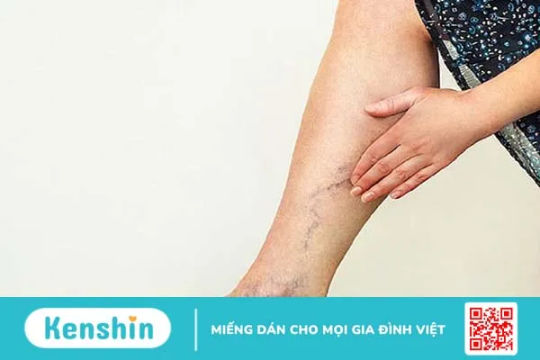 Gợi ý 6 bài tập giãn tĩnh mạch chân đơn giản tại nhà 1