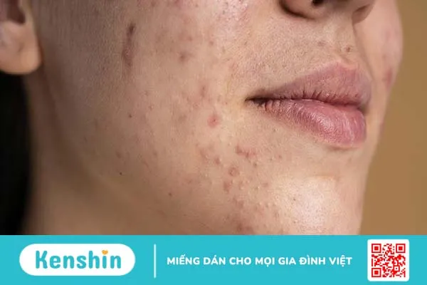 Gợi ý một vài tinh dầu trị thâm phổ biến và lưu ý khi sử dụng 1